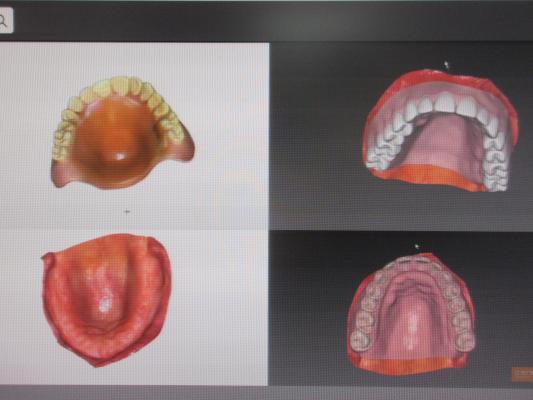 こころ歯科クリニック 将来的にはスキャンによって入れ歯も作成が可能になります